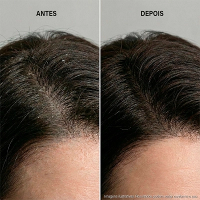 Keune Dandruff Detox - Shampoo Anticaspa 300ml Produto Keune Dandruff Detox - Shampoo Anticaspa 300ml